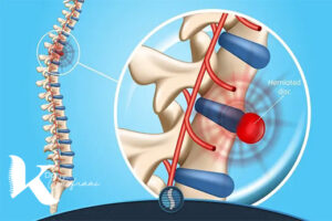 درمان جدید دیسک کمر با دیسکوژل