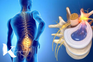 درمان دیسک کمر