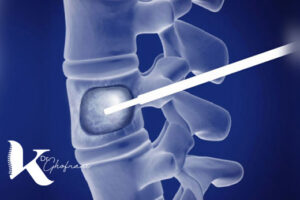 ورتبروپلاستی