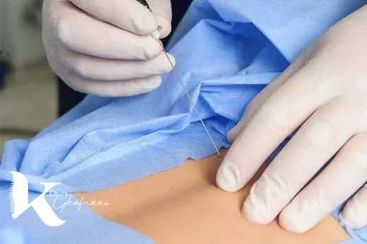 تزریق سلول های بنیادی