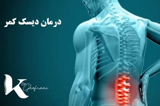 درمان دیسک کمر